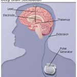 Deep Brain Stimulation